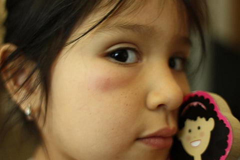 Suppressing inflammation due to mosquito bites can prevent virus from spreading infections Credit: Aleks Clark / Flicker