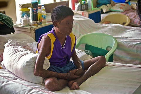 Since 2014, India had joined countries such as China, where leprosy can no more be treated by the conventional multi-drug therapy Credit: moyerphotos/Flicker