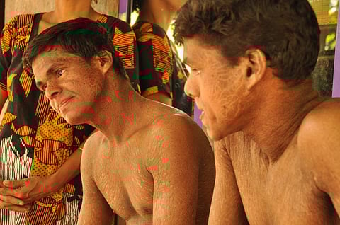 Manikantan and Sujith from Kasaragod suffer from psoriasis due to endosulfan exposure (2010) (Credit: Savvy Soumya Mishra/CSE)
