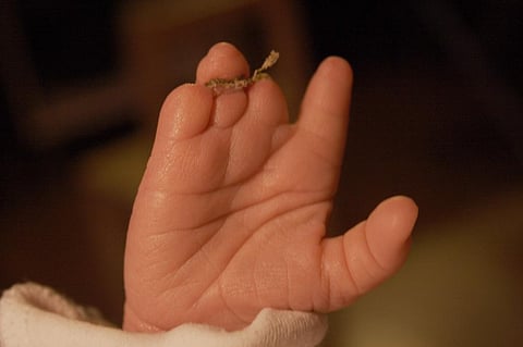 Birth defects are costly to manage in health care system and have an enormous impact on lives of children and their family. Credit: Wikimedia Commons