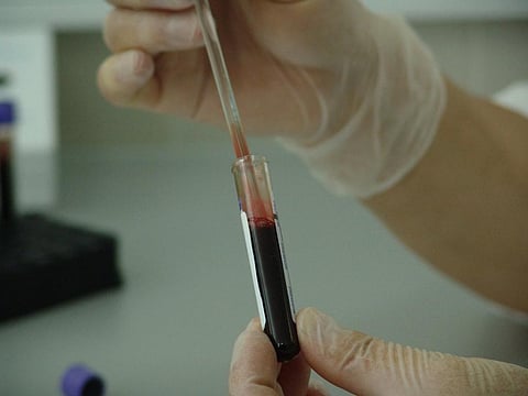 New markers will allow us to diagnose liver fibrosis through blood samples (Credit: NJ Doctors Urgent Care/Flickr)