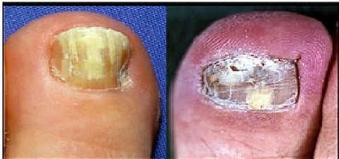Toenail fungal extract is as effective as chloramaphenicol, an antibiotic that is commercially used for treating bacterial infections of the eye, ear, throat, and blood stream.