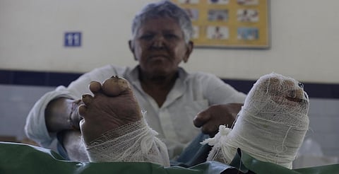 In 2014, India had the largest (58 per cent) number of new leprosy cases in the world. Credit: Vikas Choudhary
