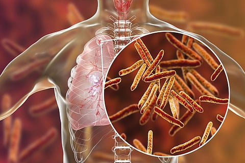 From ‘incompatible with life’ to reclaiming life, outlook on TB is changing