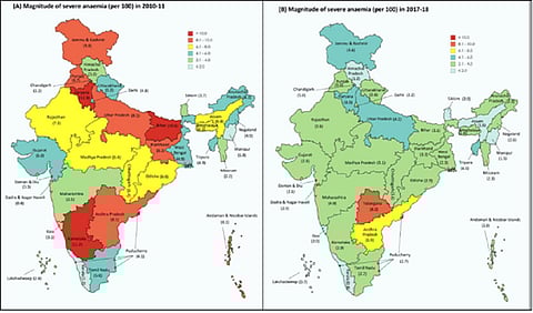 भारत में गंभीर एनीमिया के मामले घटे, पिछड़े राज्यों में सुधरे हालात