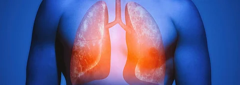 India still has the biggest TB burden