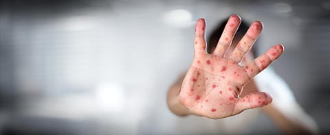 Why more measles patients die of other infections
