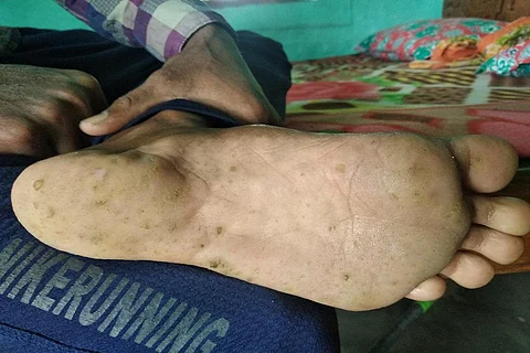 आर्सेनिक की वजह से बिहार में इस तरह के रोग बढ़ रहे हैं। फोटो: उमेश कुमार राय