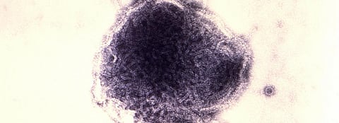 Measles campaigns suspended in most countries; 140 million lives at stake, mostly children