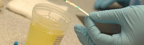 US woman's bladder produces alcohol in rare medical condition: Study