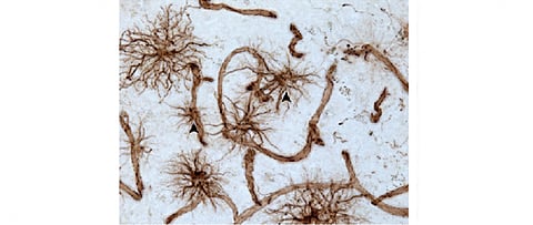 Depletion of particular brain tissue linked to chronic depression, suicide: Study