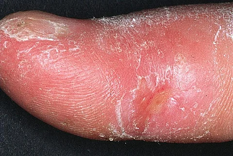 Photo : Wikimedia Commons, Systemic sclerosis finger