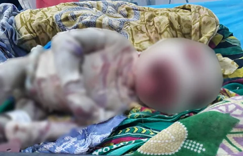 The baby born in Berhampur, Odisha, with Harlequin Ichthyosis. Photo: Hrusikesh Mohanty