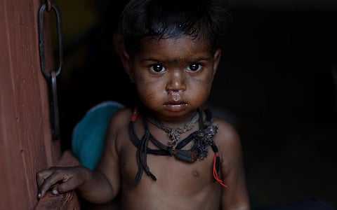 A malnourished child from the Sahariya village of Kohlapur in Shivpuri district, Madhya Pradesh. Photo: Vikas Choudhary / CSE