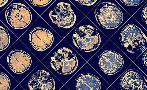 Socially isolated people have differently wired brains and poorer cognition – new research