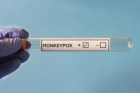 The study assessed 197 confirmed monkeypox cases between May and July 2022. Photo: iStock