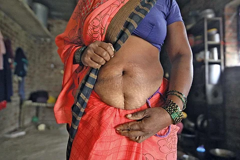 Hysterectomy is often touted as a permanent solution to benign gynaecological problems such as excessive menstrual bleeding (Photograph: Vikas Choudhary)