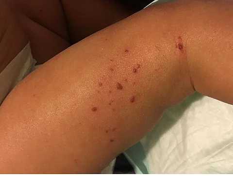 An estimated 19 per cent or more of all children under 6 years of age have eczema. Photo: Wikimedia Commons