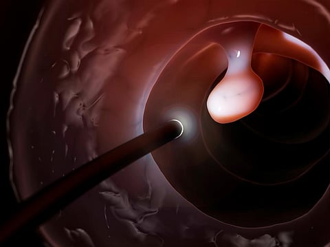 Colorectal cancer is the second-leading cause of cancer death. But by finding polyps early on, colonoscopies can detect and prevent the cancer. Photo: Sebastian Kaulitzki / Science Photo Library via Getty Images