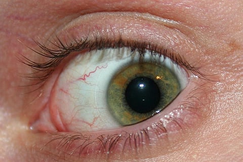 भारतीय और ब्रिटिश वैज्ञानिकों ने आंखों के संक्रमण की जांच के लिए बनाया 'स्मार्ट कॉन्टैक्ट लेंस'