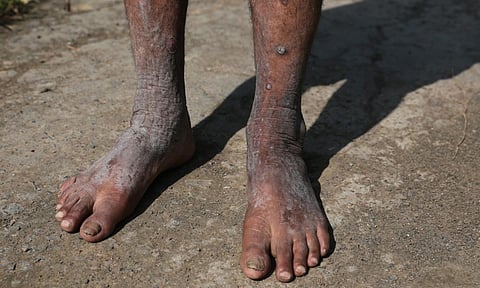 The fungal infections will add to the long list of illnesses already present among survivors. Photo: Vikas Choudhary / CSE