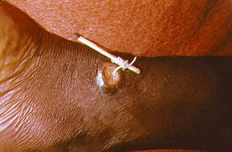 Guinea worms are long, white parasites that emerge from the legs of infected people through painful blisters
