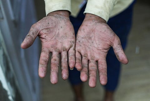 Labourers in Dharangwala are directly exposed to the canal water and have severe skin issues. Photo: Vikas Choudhary / CSE
