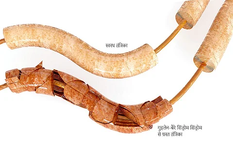 जानिए क्या है गुइलेन-बैरे सिंड्रोम, जिसके चलते पेरू में लगाना पड़ा स्वास्थ्य आपातकाल