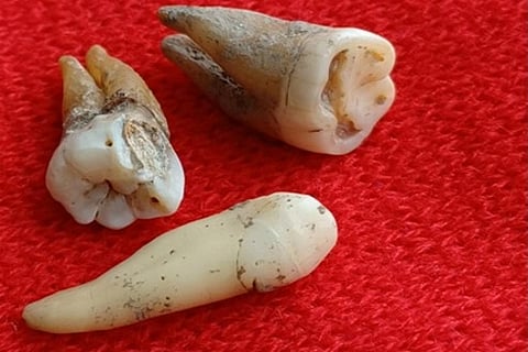 800 साल पुराने मध्ययुगीन इंसानी दांतों में मिले एंटीबॉडी; फोटो: यूनिवर्सिटी ऑफ नॉटिंघम