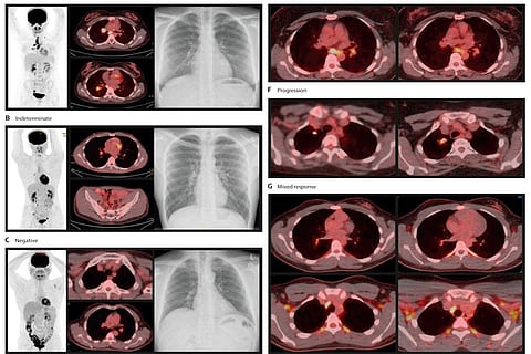 फोटो साभार: द लांसेट माइक्रोब