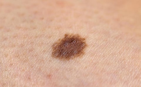 Melanoma usually appears as an irregular looking mole. Photo: iStock