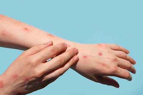Mpox still global public health emergency. Here's why WHO terms latest upsurge 'extraordinary'