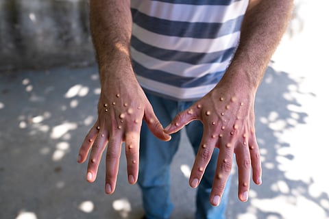 Mpox outbreak: WHO scrambles to ensure access to diagnostic tests, invites manufacturers for assessing preparedness