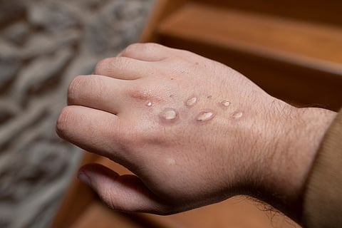 Mpox vesicles on a hand.