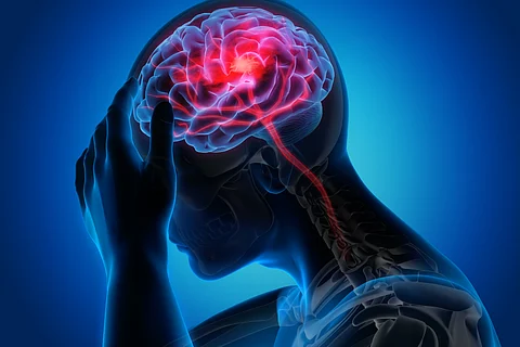 Study finds 50 times higher levels of micro- and nanoplastics in stroke patients’ arteries