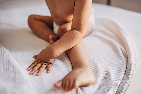 Little boy with with hand foot and mouth disease sitting on bed.