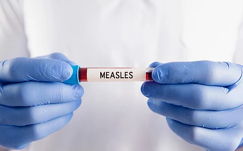 Virologists raise alarm over surge in measles cases worldwide