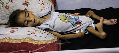 A child suffering from malnutrition lies on a bed in the Patient Society Hospital in Gaza City.
