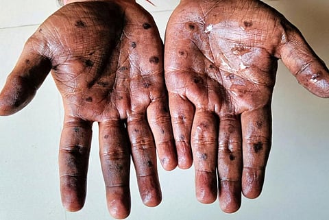 इस साल कांगो लोकतांत्रिक गणराज्य में 6,500 से अधिक मामले और 345 मौतें दर्ज की गई हैं। इनमें से लगभग आधे 15 वर्ष से कम उम्र के बच्चे हैं।