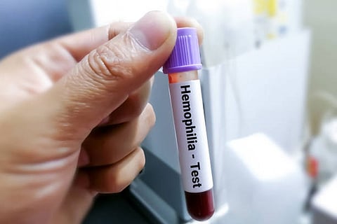 हीमोफीलिया (पीडब्ल्यूएच) से पीड़ित लोगों के उपचार के लिए पिछले साल हीमोफीलिया और हेल्थ कलेक्टिव ऑफ नॉर्थ (एचएचसीएन) ने राष्ट्रीय दिशा-निर्देश द्वारा जारी किए गए।