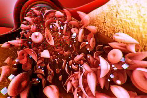 नया अध्ययन बताता है कि माइक्रोप्लास्टिक धमनियों में सूजन बढ़ाकर हृदय रोग को तेज कर सकते हैं विशेषकर पुरुषों में