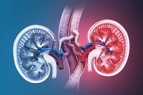 किडनी रोग के प्रमुख कारणों में मधुमेह, उच्च रक्तचाप, मोटापा, धूम्रपान और अस्वस्थ जीवनशैली शामिल हैं।