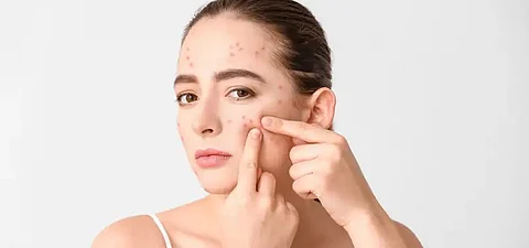 pimples