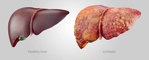 Liver Cirrhosis