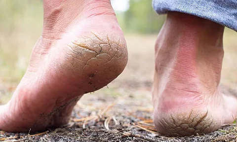 heel fissures