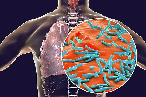 tuberculosis symptoms