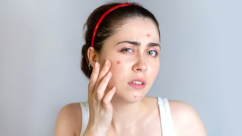 prevent acne in mansoon