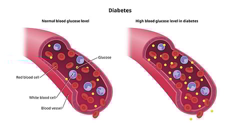 how to form Diabetes in your body in tamil