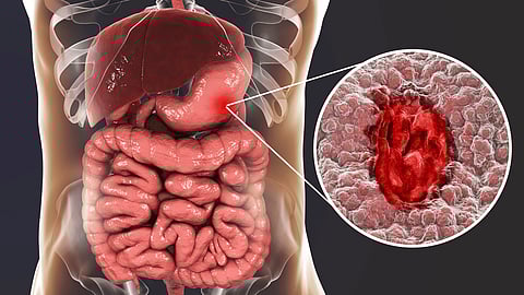 how to cure ulcer in stomach naturally in tamil