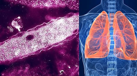 New York Legionnaires' disease